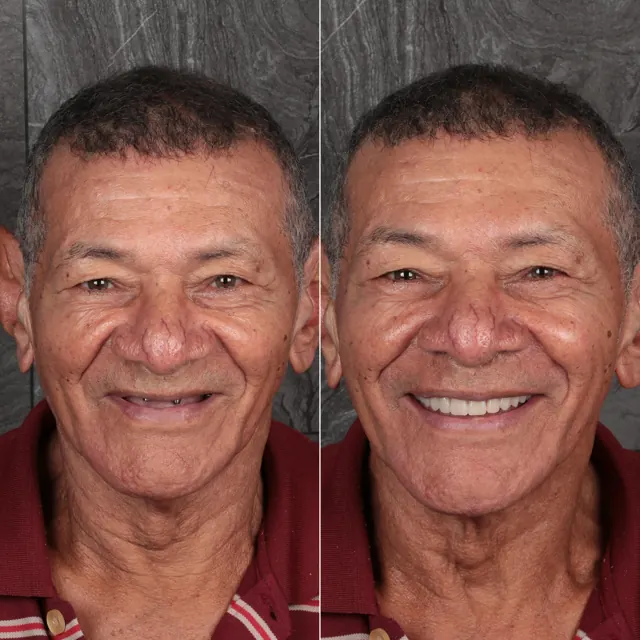 Antes e depois de paciente da Odonto Qualit — Reabilitação com implantes