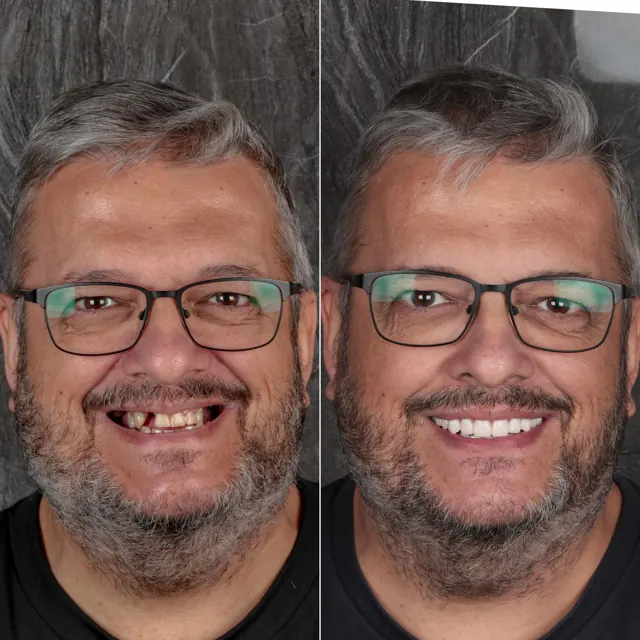 Antes e depois de paciente da Odonto Qualit — Reabilitação com implantes