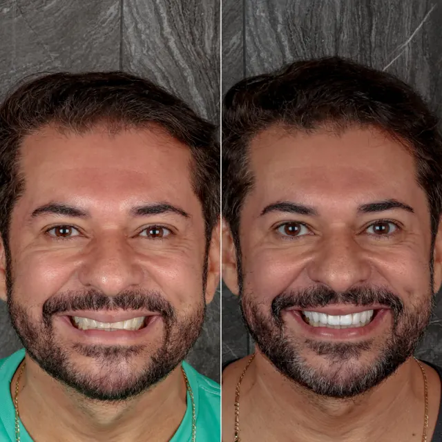 Antes e depois de paciente da Odonto Qualit — Estética do sorriso
