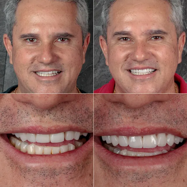 Antes e depois de paciente da Odonto Qualit — Reabilitação do sorriso