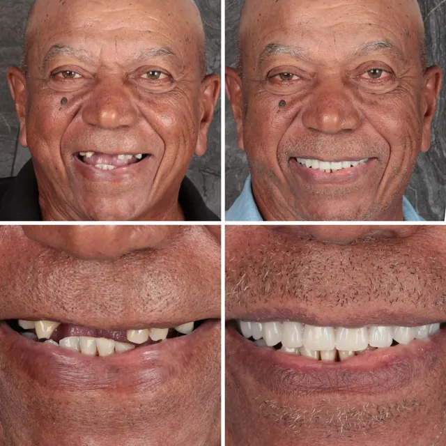 Antes e depois de paciente da Odonto Qualit — Prótese fixa sobre implantes