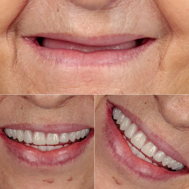 Antes e depois de paciente da Odonto Qualit — Reabilitação total