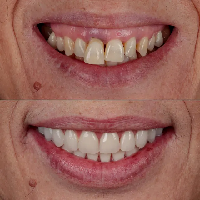 Antes e depois de paciente da Odonto Qualit — Lentes de contato dental