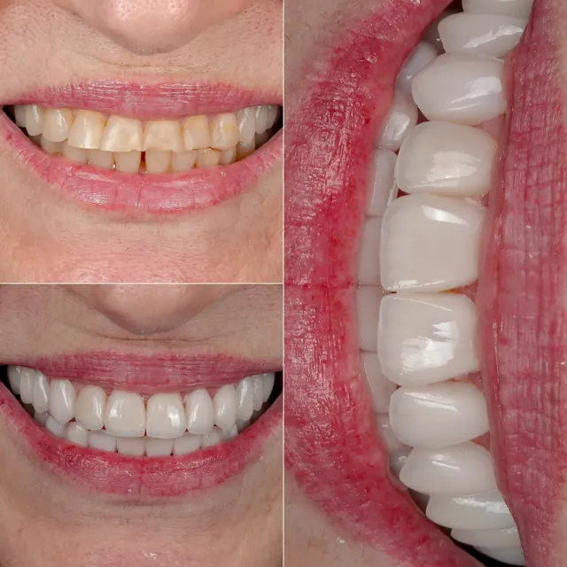 Antes e depois de paciente da Odonto Qualit — Lentes de contato dental