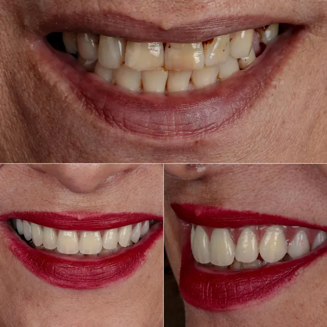 Antes e depois de paciente da Odonto Qualit — Reabilitação estética