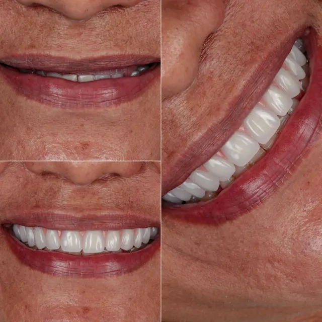 Antes e depois de paciente da Odonto Qualit — Prótese protocolo