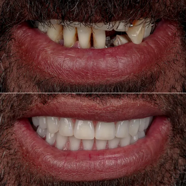 Antes e depois de paciente da Odonto Qualit — Prótese protocolo