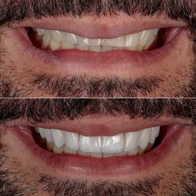 Antes e depois de paciente da Odonto Qualit — Reabilitação com implantes
